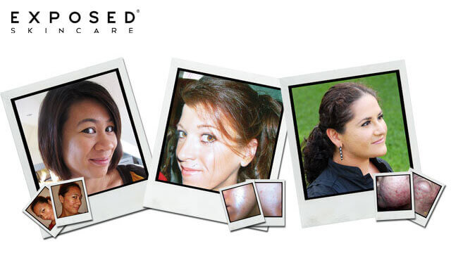 Exposed Skincare Success Stories